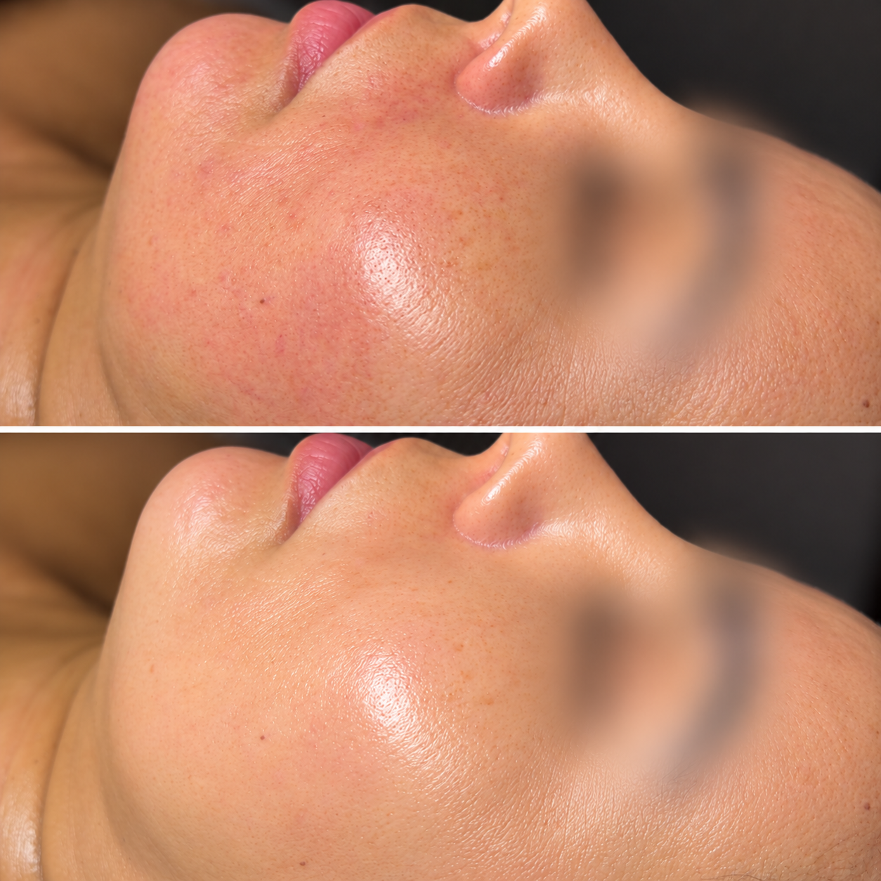 Unretouched before-and-after close-up of a client's cheek and mouth area following a professional skincare treatment